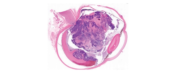 histogram of a retinoblastoma